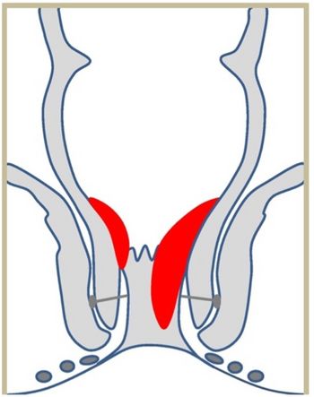 innere Hämorrhoiden